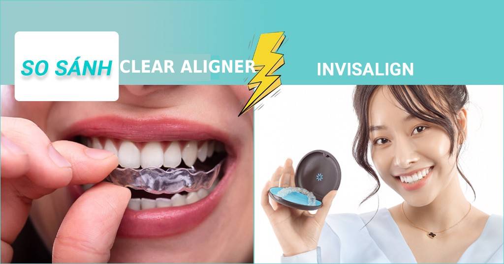 Niềng răng Invisalign và Clear Aligner có nhiều điểm tương đồng